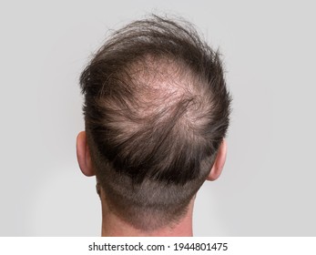 Back of head close up showing a young caucasian man who is experiencing the early stages of hair loss and going bald. 
				Male pattern baldness concept, isolated on white background with room for text.