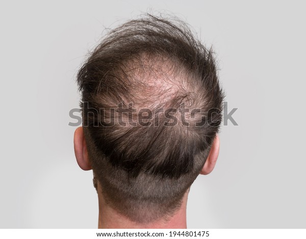Back of head close up showing a young caucasian man\
who is experiencing the early stages of hair loss and going bald.\
\
Male pattern baldness concept, isolated on white background with\
room for text.