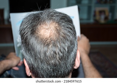 Back Of Head Man Close Up With Thinning - Man Bald Spot In Head – Man With Alopecia On His Head – Man With Hair Loss Problem 
