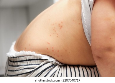 Back of Small Child with Red Rash. Baby with Red Spots Blisters on the skin. Close up of Painful Rash. Health Problem. Rubella, Chickenpox, Scarlet fever, Measles. Bacterial Infections, Disease. Mpox