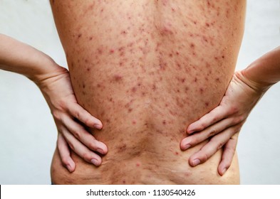 Back of teenager with acne skin ,pimples and patches. Problematic young male skin.