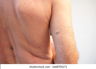 Back View Of A Caucasian Showing Seborrheic Keratosis At His Right Upper Arm.  The White Mole Has Cracks.  It Is Most Common Noncancerous Skin Growths In Adults.  Not Contagious.