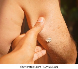 Back View Of A Caucasian Showing Seborrheic Keratosis At His Right Upper Arm.  The White Mole Has Cracks. It Is Most Common Noncancerous Skin Growths In Adults.  Not Contagious.