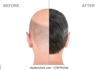 Hair Growth Before After Hd Stock Images Shutterstock