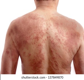 皮膚炎 の画像 写真素材 ベクター画像 Shutterstock