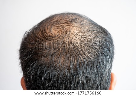 Back view of men's head with thin hair and grey hair growing. Conceptual of hair problem on men's head.