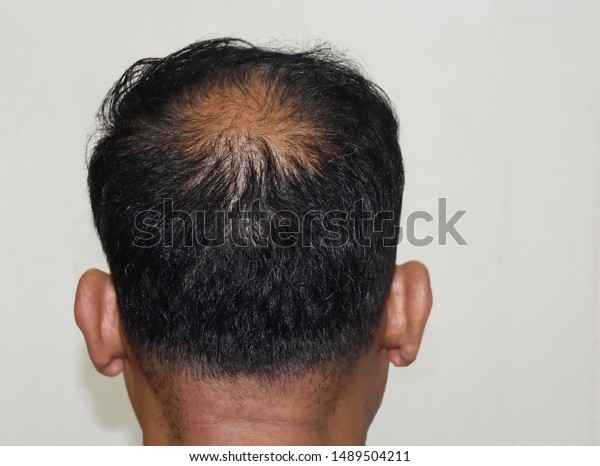 Back View Thin Hair Male Hair Stock Photo Edit Now 1489504211