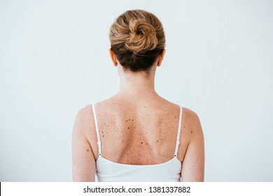 Back View Of Woman With Melanoma On Diseased Skin Isolated On White 