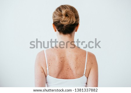 back view of woman with melanoma on diseased skin isolated on white 