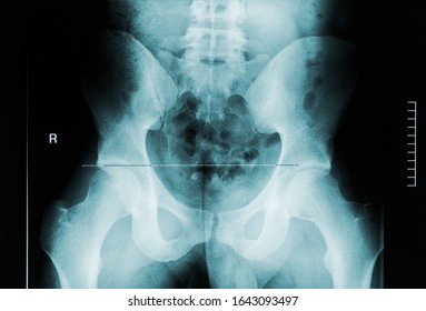 Back View X-ray Image Of Male Pelvis, Femoral Neck And Lumbar Vertebrae. Medical And Human Anatomy Imagery.