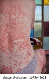 Back Of Woman With Psoriasis Sitting On A Chair