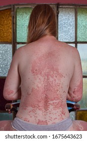 Back Of Woman With Psoriasis Sitting On A Chair