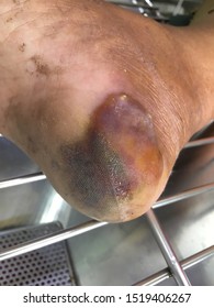 Back Wound Rattlesnake Bite At Heel.