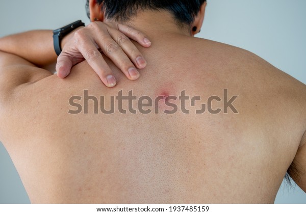 The back of a young Asian man with red abscesses\
or pimples.