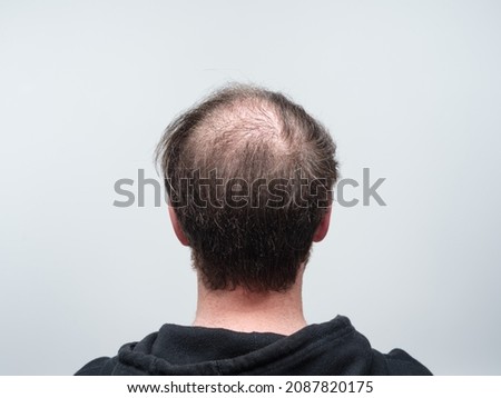 Back of a young balding man's head showing clear signs of concentrated hair loss around the scalp area. Male pattern baldness concept against a clear white background with room for text.