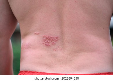 The back of a young man with herpes zoster. Red vesicular lesion of the skin on the back. Dermatological problems on the body. Inflamed skin with watery papules.