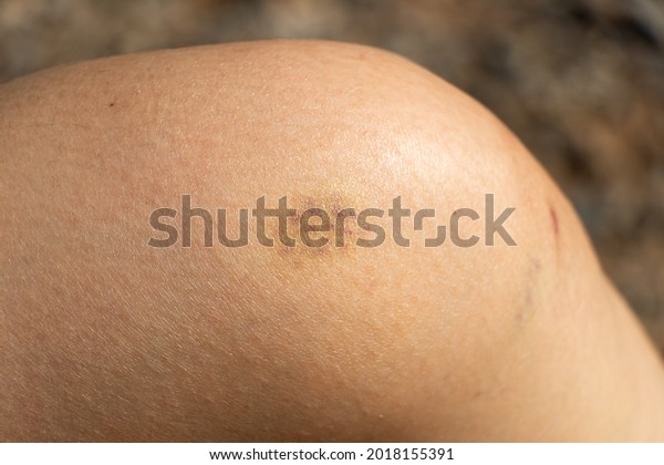 Background Bruised Wound On Wound Woman Stock Photo 2018155391