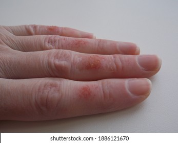 Chemical Burn Hand Hd Stock Images Shutterstock