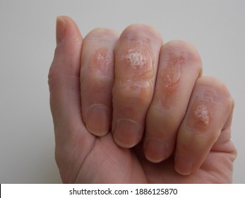 Chemical Burn Hand Hd Stock Images Shutterstock