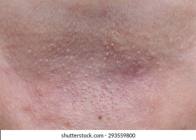 Backgrounf Of Prickly Heat On The Skin