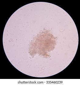 Bacteria Clumping Urine Sediment Stock Photo 335460239 | Shutterstock