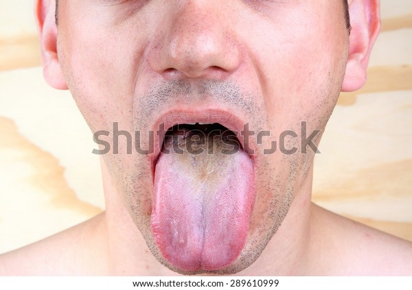 Bacterial Infection Disease Tongue Man Stock Photo (Edit Now) 289610999