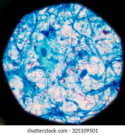 Bacterial Infection Tuberculosis.red Cells In Blue Background.AFB 3+