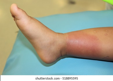 Bacterial Skin infection on a child's right lower leg called erysipelas involving the upper dermis and superficial cutaneous lymphatics as well-defined margin redness, warmth,  swelling and tenderness