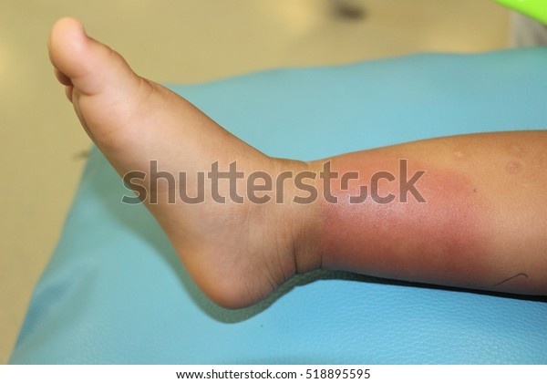 細菌性皮膚感染在孩子右下腿被稱為丹毒 涉及上真皮和皮膚淋巴細胞 以及明確定義的邊緣紅腫 溫暖 腫脹和壓痛庫存照片 立刻編輯