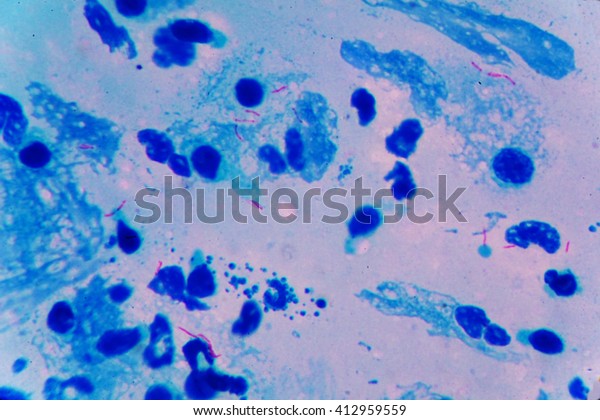 the bacterium Mycobacterium\
tuberculosis undermicroscope 100x /AFB POSITIVE showing\

