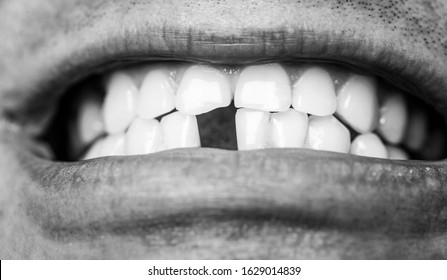 Bad Dental Health, No Teeth, No Fluoride, Tooth Erosion. Man Without One Front Tooth. No Teeth. Smile Men With A Lost Front Tooth, Toothache. Black And White.