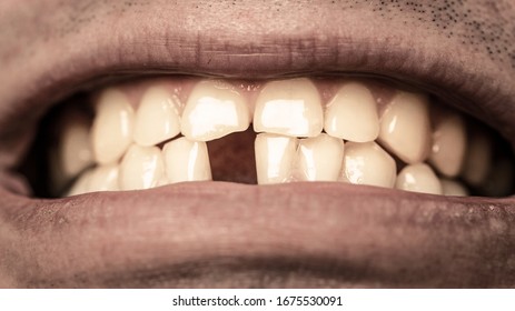 Bad Dental Health, No Teeth, No Fluoride, Tooth Erosion. No Teeth. Smile Men With A Lost Front Tooth, Toothache. Yellow Teeth. Man Without One Front Tooth.