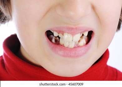 Bad Female Child Teeth