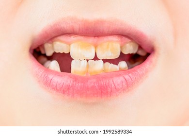 Bad Teeth Child. Portrait Boy With Bad Teeth. Child Smile And Show Her Crowding Tooth. Close Up Of Unhealthy Baby Teeths. Kid Patient Open Mouth Showing Cavities Teeth Decay.