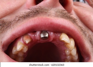 Bad teeth, dental implant in the oral cavity (human mouth)