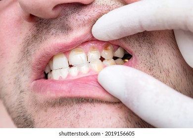 Bad Teeth Of A Middle-aged Man. Chipped And Cracked Tooth Enamel, Enamel Hypoplasia, Malocclusion And Dental Crowns. Negligent Attitude Towards Your Health, Concept.