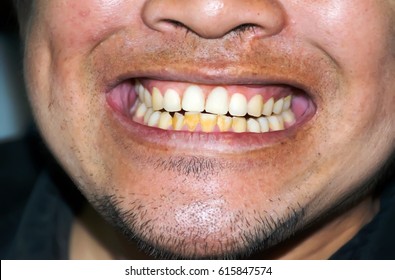 Bad Teeth Teeth Smile Before Treatment Stock Photo 615847574 | Shutterstock