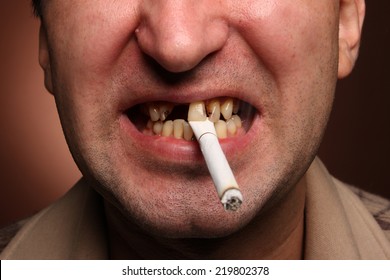 Bad Teeth Smoker Sick