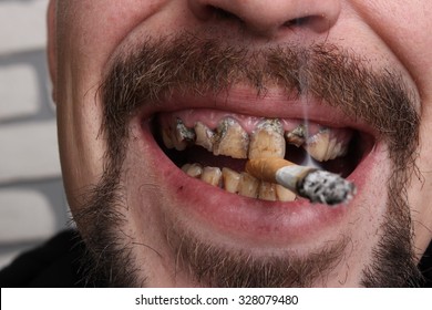 Smokers Teeth Hd Stock Images Shutterstock