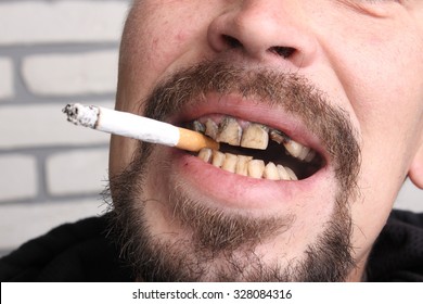 Bad Teeth Smoker Sick