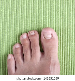 Badly Infected Ingrown Toenail