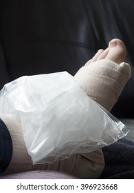 Bag Of Ice On A Broken, Fractured Or Sprained Foot Or Ankle In Cast