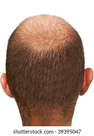 Bald Hair Head Of Adult Men Completely Balding