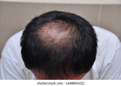 Male Pattern Baldness Hair Loss Early Stock Photo (Edit Now) 1019163178