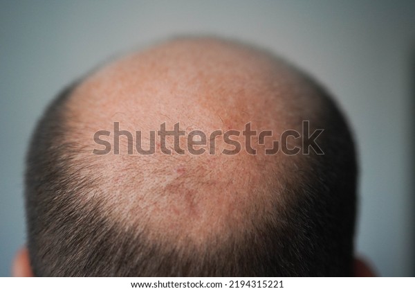 Bald head close-up. The problem of hair loss in men.
Alopecia in men.
