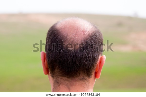 Bald Head Nape Head Baldness Hair Stock Photo Edit Now 1099843184