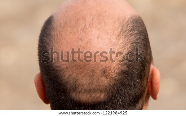 Bald Head Nape Head Baldness Hair Royalty Free Stock Image