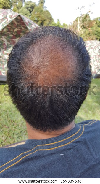 Bald Male Head Rear Thinning Hair People Healthcare Medical
