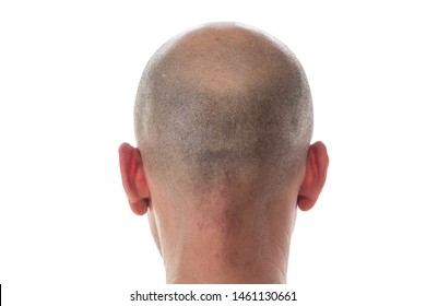 Bald Man Back View, Head With Hair Loss