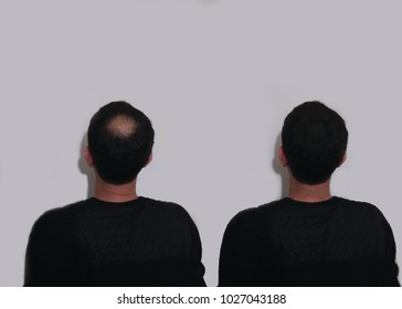 a bald man before and after bald head of a man on white background. bald man. before and after hair transplantation.